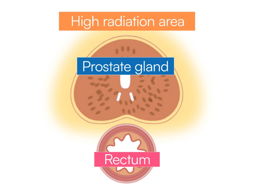 Illustration : Short-term proton therapy after spacer implantation for prostate cancer (before treatment)