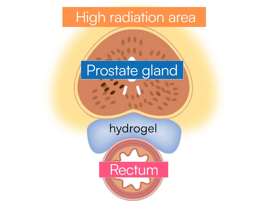 Illustration : Short-term proton therapy after spacer implantation for prostate cancer (after treatment)