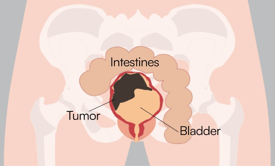 Illustration : Before treating cancer in the abdominal area