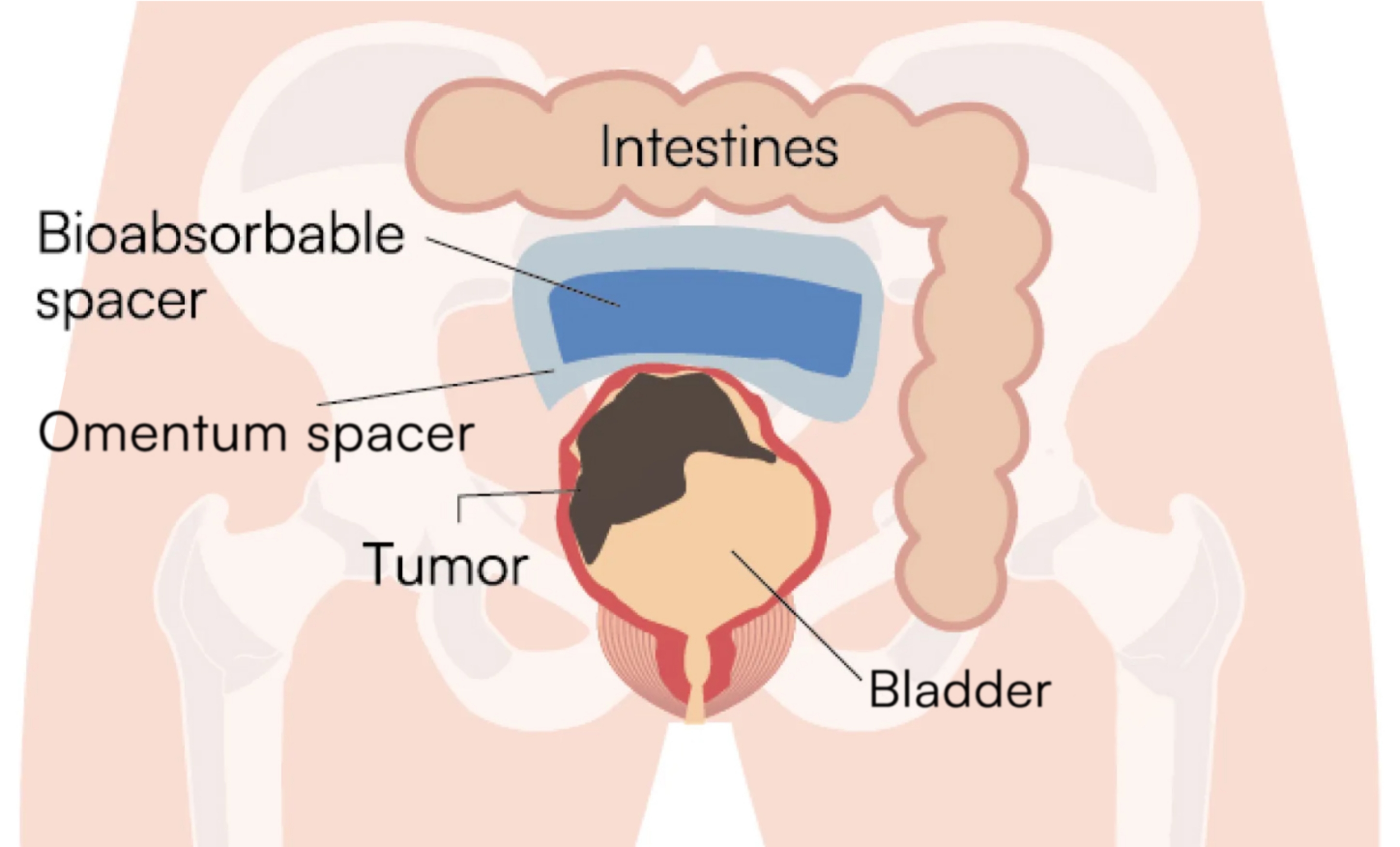 Illustration : After treatment for cancer in the abdominal area