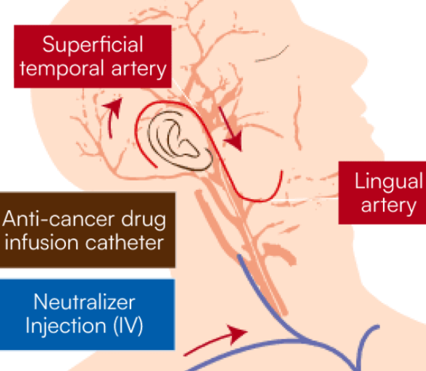 Illustration : Retrograde dynamic chemotherapy for advanced tongue cancer