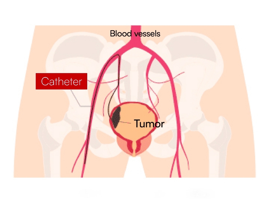 Illustration : Retrograde dynamic chemotherapy for advanced tongue cancer